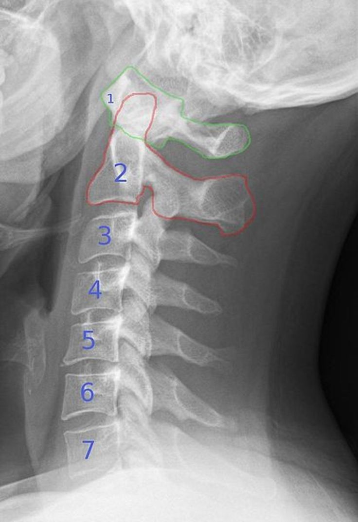 Cervical Osteoarthritis